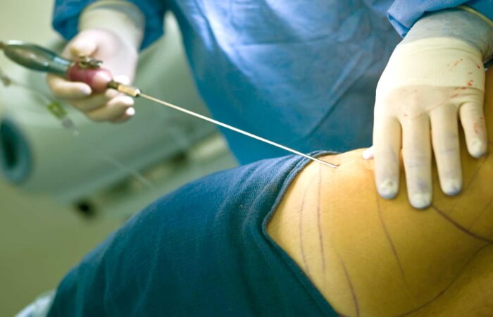 هروب طبيب أجنبي بعد تسببه بوفاة شابة عراقية نتيجة فشل عملية شفط دهون في بغداد