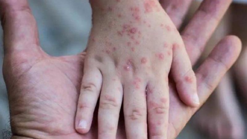 صدمة.. الدواء المستخدم لـ”جدري القرود” ليس “فعالا” ضد الفيروس