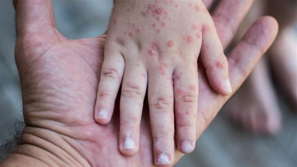 منظمة الصحة العالمية تعلن حالة الطوارئ العامة بسبب تفشي جدري القردة