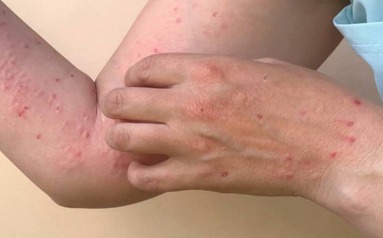 الصحة الأردنية: تسجيل أول إصابة بـ “جدري القردة” لمقيم غير أردني