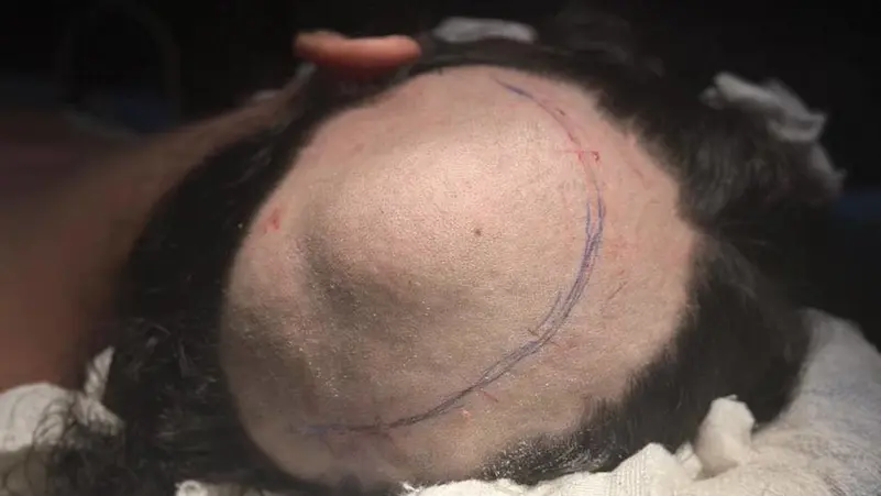 بتقنية 3D المبتكرة.. صور جراحة خطيرة لإزالة ورم بعظام جمجمة فتاة مصرية