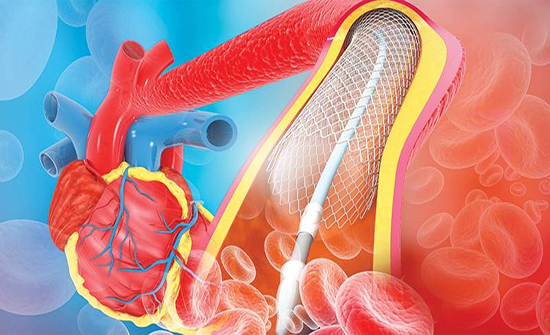 دراسة أمريكية: الدعامات ليست أفضل من الأدوية بالنسبة لكثير من مرضى القلب