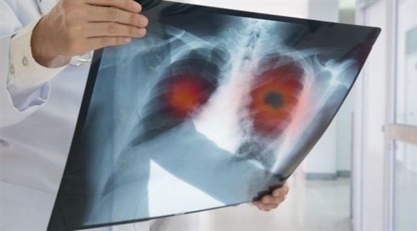 تقنية جديدة لكشف سرطان الرئة مبكراً