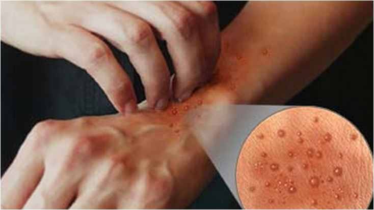 فوائد الزيوت الطبيعية لعلاج حكة الجسم